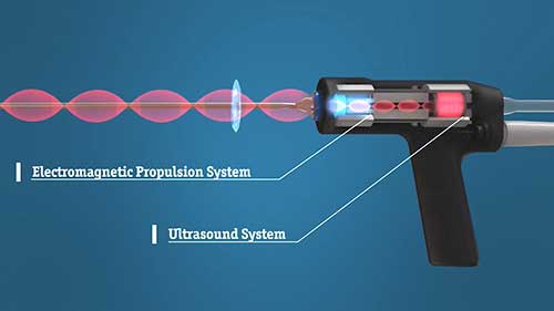 瑞士超声碎石机