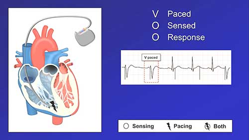 起搏器的模式与设置