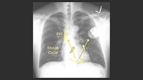 除颤器与起搏器