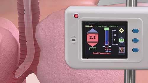 美国的气道监测系统