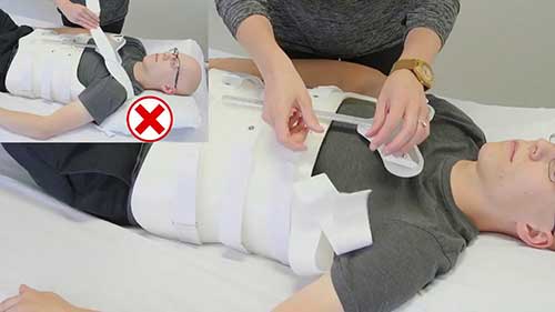 胸腰骶矫形器（TLSO）