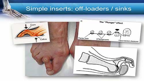 足踝矫形器的原理