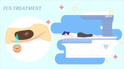 聚焦超声与肿瘤治疗