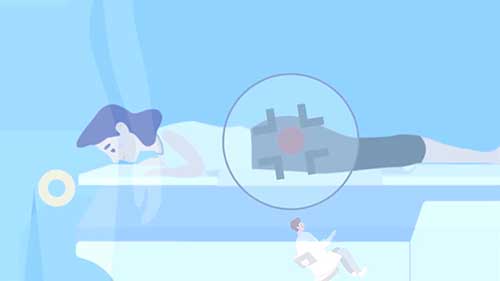 聚焦超声与前列腺癌