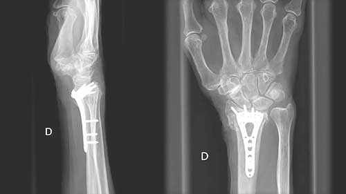 骨密度测定检查
