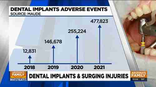 种植牙失败原因