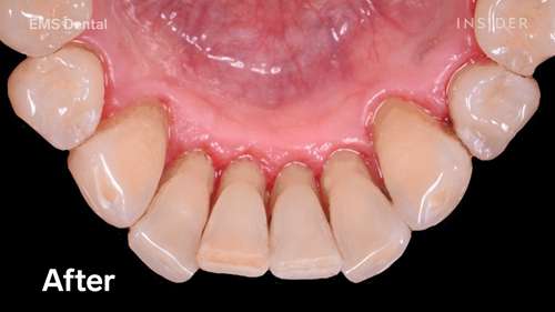 如何深度清洁牙齿