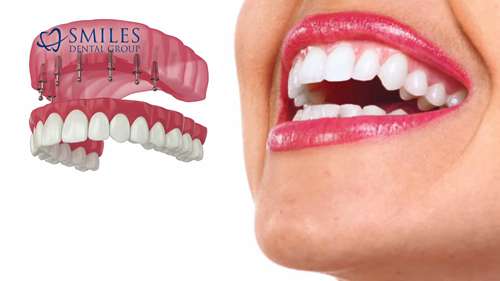 如何选择适合自己的义齿