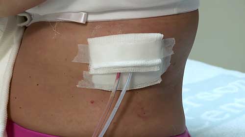 如何护理术后伤口引流系统