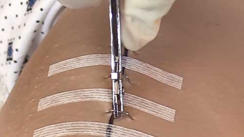 如何拆除手术缝合钉