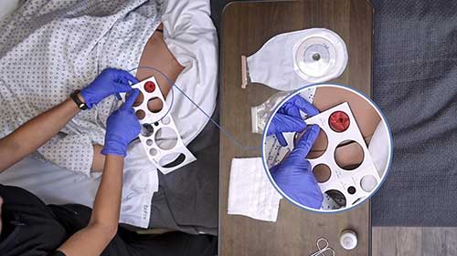 如何更换造口袋