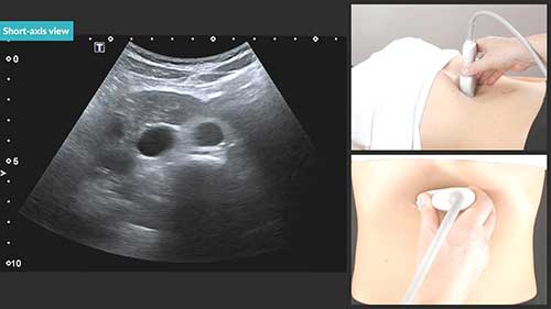 下腔静脉超声检查