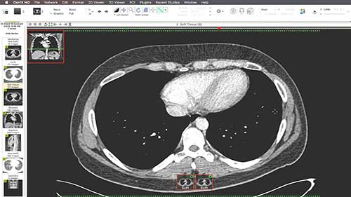 如何读懂胸部CT影像图
