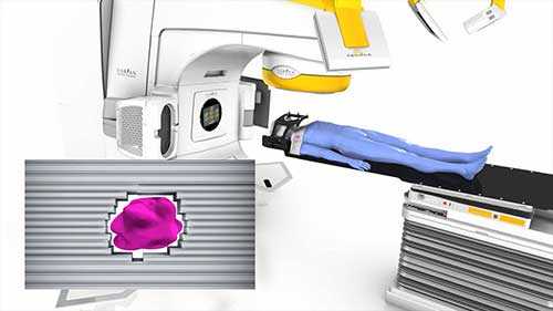 立体定向放疗与普通放疗的区别