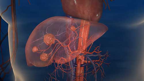选择性内放射治疗工作原理