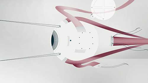 脉络膜黑色素瘤的放射敷贴治疗