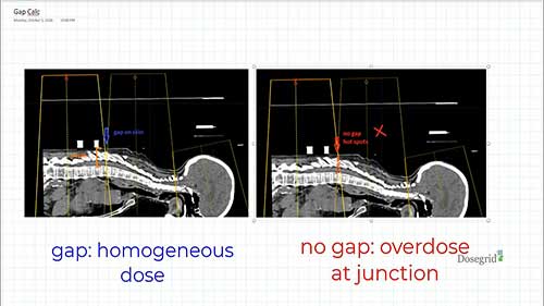 剂量计算：间隙计算