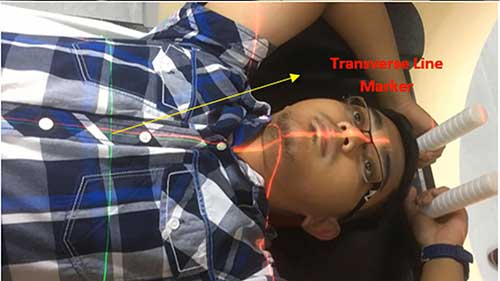 肺癌放射治疗计划