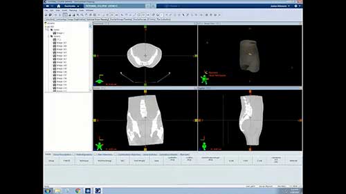 Eclipse放疗计划系统：制定计划