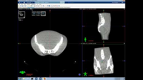 Eclipse放疗计划系统：轮廓勾画
