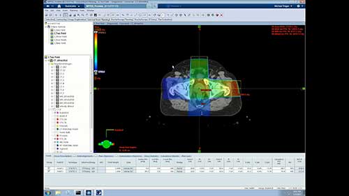 Eclipse放疗计划系统：三维放疗计划