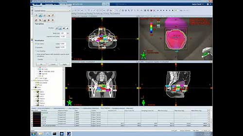 Eclipse放疗计划系统：计划分析
