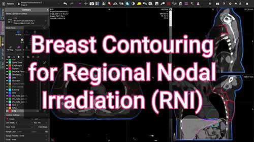 乳腺癌区域淋巴结放疗勾画01