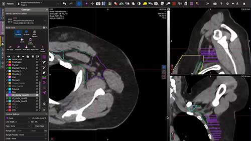 乳腺癌区域淋巴结放疗勾画02