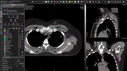 乳腺癌区域淋巴结放疗勾画03