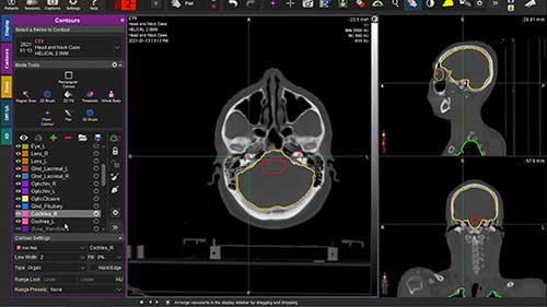 头颈部危及器官的勾画02