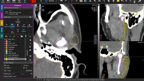 头颈部危及器官的勾画03