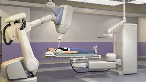 什么是射波刀治疗