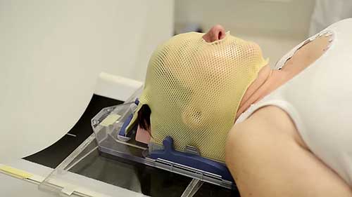 脑肿瘤射波刀治疗