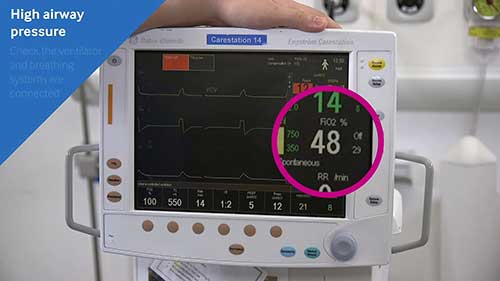 缺氧和气道压力增高
