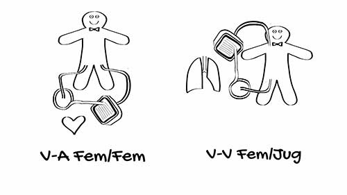 体外膜肺氧合：简要介绍