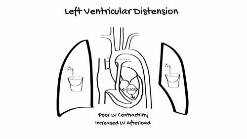 体外膜肺氧合：静脉-动脉体外膜肺氧合
