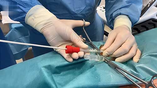 静脉-动脉体外膜肺氧合插管