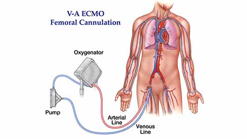 VAECMO股动脉插管