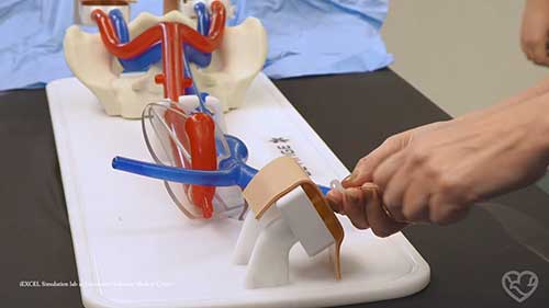 VAECMO插管的替代策略