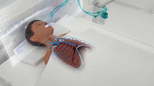 机械通气与体外膜肺氧合