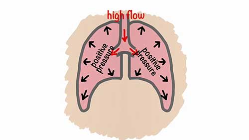 无创通气模式：CPAP