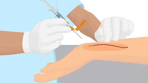 动脉血气标本采集