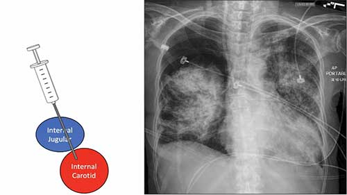ICU课程：静脉管路