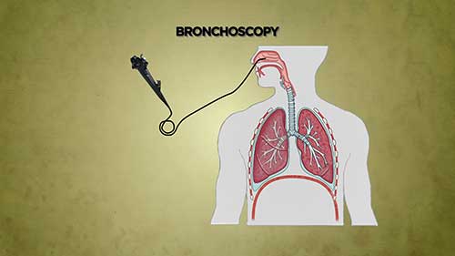 什么是支气管镜检查