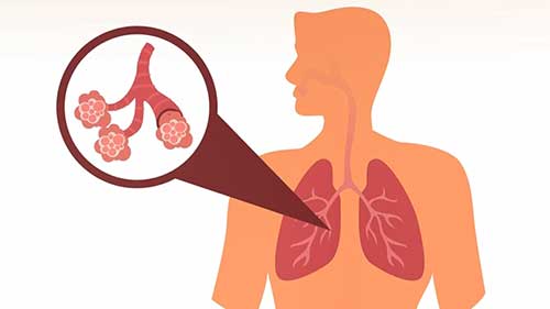 支气管肺泡灌洗概述