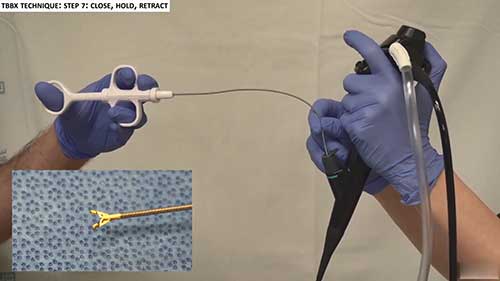 经支气管镜活检