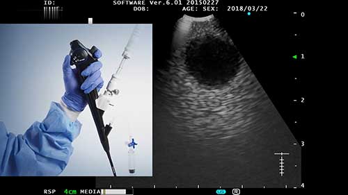 经气管镜超声引导针吸活检：定位病变