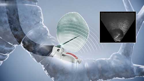 经气管镜超声引导针吸活检：扇形穿刺