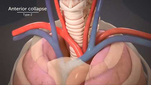 如何治疗气管软化