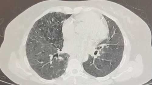 经支气管冷冻肺活检